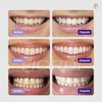 Sérum V34™ - Clareador Dentário + Brinde