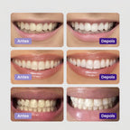 Clareador Dentário - Sérum V34™ + Brinde