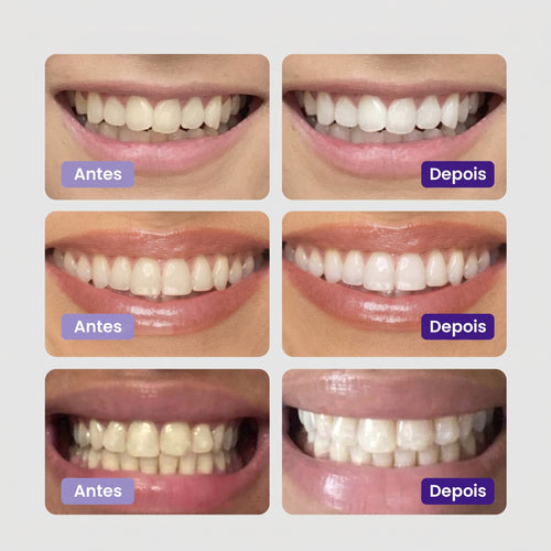 Clareador Dentário - Sérum V34™ + Brinde